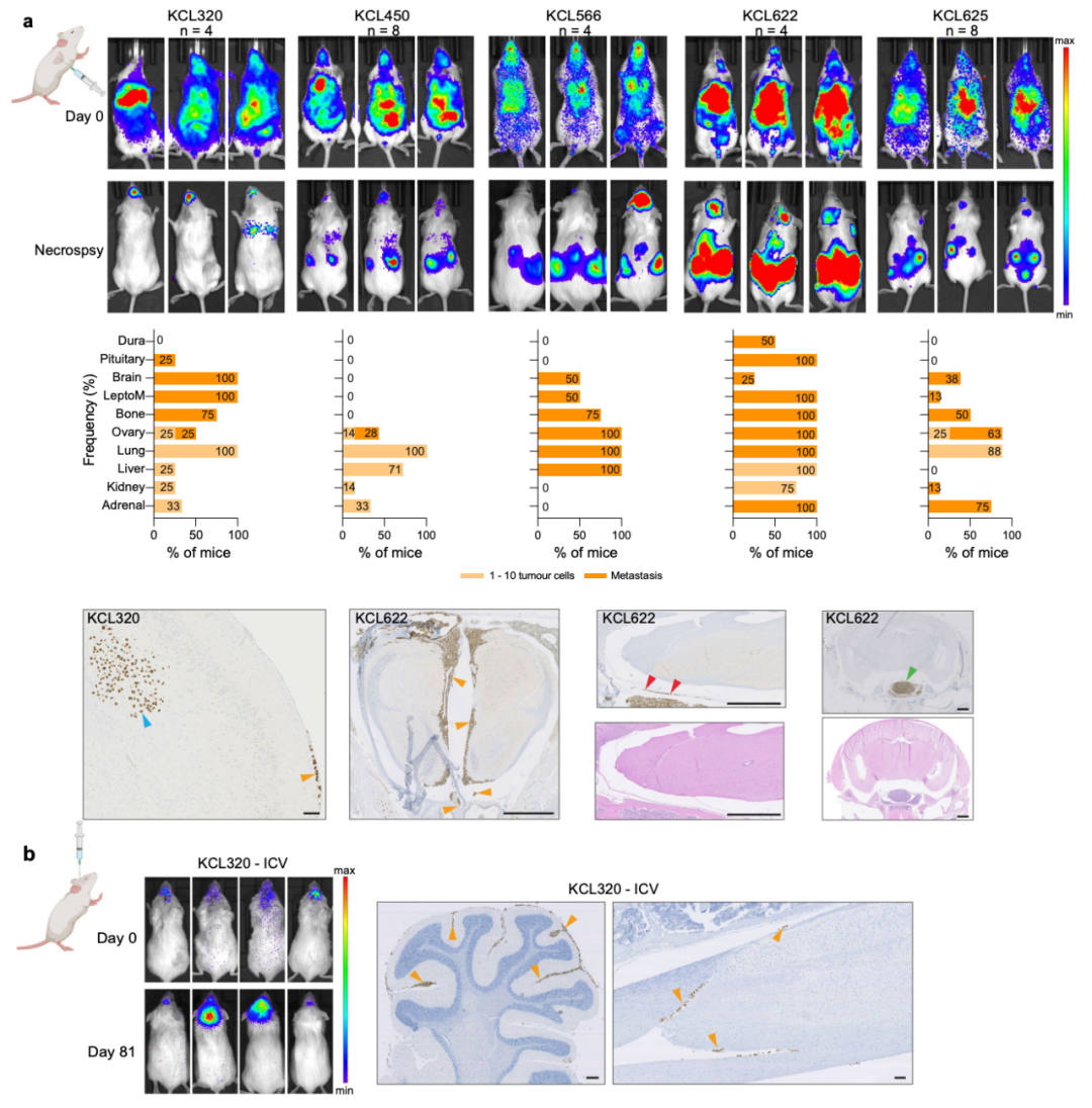 Nature子刊:患者來源的類器官,為乳腺癌腦轉移帶來新見解 Nature子刊:患者來源的類器官,為乳腺癌腦轉移帶來新見解